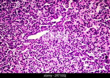 Carcinoma epatocellulare, cancro del fegato, micrografia leggera, foto al microscopio Foto Stock