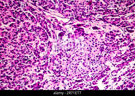 Carcinoma epatocellulare, cancro del fegato, micrografia leggera, foto al microscopio Foto Stock