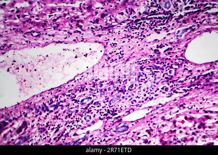 Carcinoma epatocellulare, cancro del fegato, micrografia leggera, foto al microscopio Foto Stock