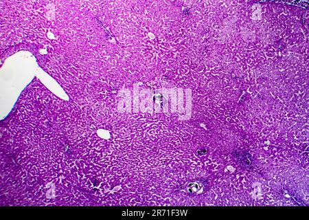 Schistosomiasi epatica, micrografia leggera, foto al microscopio che mostra la presenza di schistosoma ovulo, uova calcificate del verme piatto, nel tessuto epatico Foto Stock