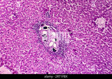 Schistosomiasi epatica, micrografia leggera, foto al microscopio che mostra la presenza di schistosoma ovulo, uova calcificate del verme piatto, nel tessuto epatico Foto Stock