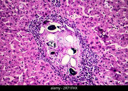 Schistosomiasi epatica, micrografia leggera, foto al microscopio che mostra la presenza di schistosoma ovulo, uova calcificate del verme piatto, nel tessuto epatico Foto Stock