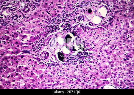 Schistosomiasi epatica, micrografia leggera, foto al microscopio che mostra la presenza di schistosoma ovulo, uova calcificate del verme piatto, nel tessuto epatico Foto Stock