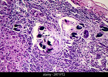 Schistosomiasi epatica, micrografia leggera, foto al microscopio che mostra la presenza di schistosoma ovulo, uova calcificate del verme piatto, nel tessuto epatico Foto Stock