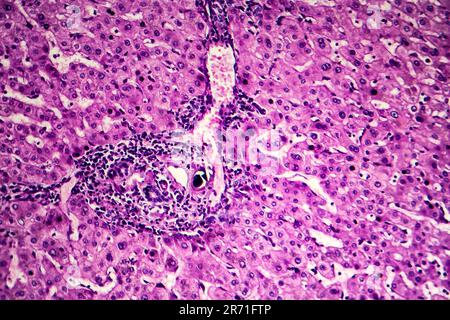 Schistosomiasi epatica, micrografia leggera, foto al microscopio che mostra la presenza di schistosoma ovulo, uova calcificate del verme piatto, nel tessuto epatico Foto Stock