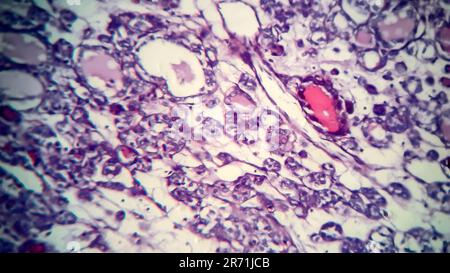 Carcinoma follicolare tiroideo, micrografia leggera, foto al microscopio Foto Stock