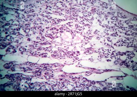 Carcinoma follicolare tiroideo, micrografia leggera, foto al microscopio Foto Stock