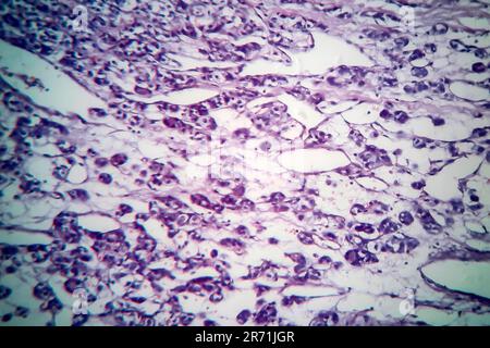 Carcinoma follicolare tiroideo, micrografia leggera, foto al microscopio Foto Stock