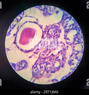 Carcinoma follicolare tiroideo, micrografia leggera, foto al microscopio Foto Stock