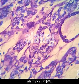 Carcinoma follicolare tiroideo, micrografia leggera, foto al microscopio Foto Stock