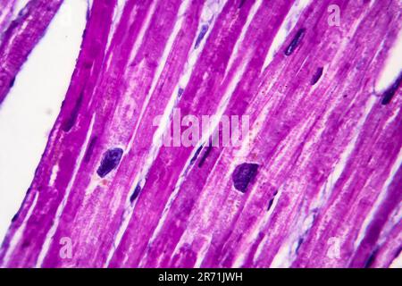 Istopatologia di ipertrofia cardiaca, elevato ingrandimento. Fotomicrografia che mostra miocardio ipertrofico con fibre muscolari spesse e ingrandito e dar Foto Stock