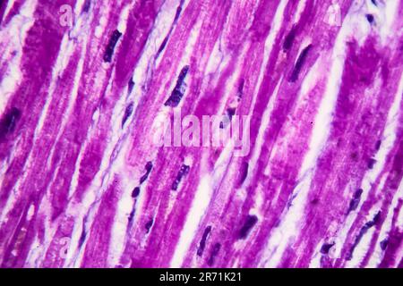 Istopatologia di ipertrofia cardiaca, elevato ingrandimento. Fotomicrografia che mostra miocardio ipertrofico con fibre muscolari spesse e ingrandito e dar Foto Stock