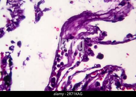 Istopatologia del polmone del fumatore. Micrografia leggera che mostra l'accumulo di particelle di carbonio nel tessuto polmonare Foto Stock