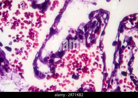 Istopatologia del polmone del fumatore. Micrografia leggera che mostra l'accumulo di particelle di carbonio nel tessuto polmonare Foto Stock