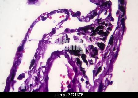 Istopatologia del polmone del fumatore. Micrografia leggera che mostra l'accumulo di particelle di carbonio nel tessuto polmonare Foto Stock