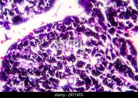 Istopatologia del polmone del fumatore. Micrografia leggera che mostra l'accumulo di particelle di carbonio nel tessuto polmonare Foto Stock