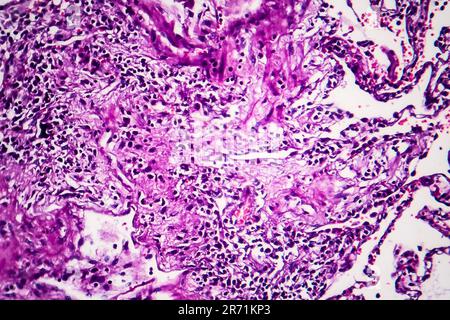 Istopatologia del polmone del fumatore. Micrografia leggera che mostra l'accumulo di particelle di carbonio nel tessuto polmonare Foto Stock