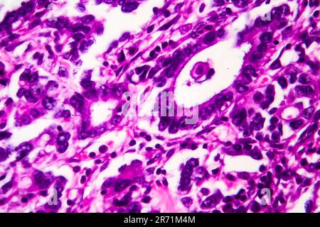 Adenocarcinoma gastrico, micrografia leggera, foto al microscopio. Ingrandimento elevato Foto Stock