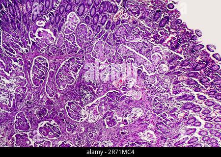 Scarsamente differenziato adenocarcinoma intestinale, micrografia di luce, foto al microscopio Foto Stock