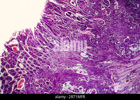 Scarsamente differenziato adenocarcinoma intestinale, micrografia di luce, foto al microscopio Foto Stock