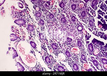Scarsamente differenziato adenocarcinoma intestinale, micrografia di luce, foto al microscopio Foto Stock