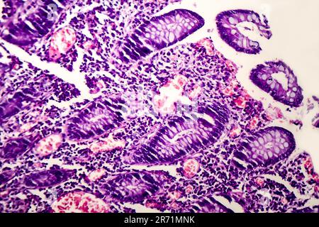 Scarsamente differenziato adenocarcinoma intestinale, micrografia di luce, foto al microscopio Foto Stock
