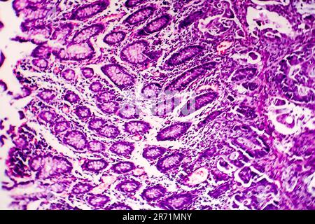 Scarsamente differenziato adenocarcinoma intestinale, micrografia di luce, foto al microscopio Foto Stock