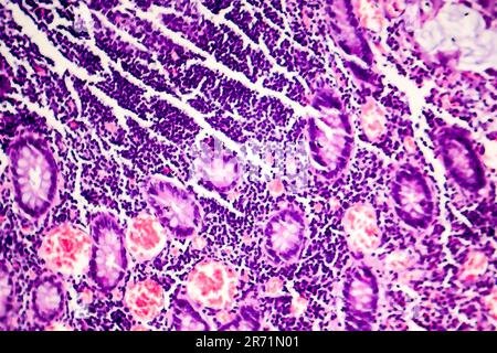 Scarsamente differenziato adenocarcinoma intestinale, micrografia di luce, foto al microscopio Foto Stock