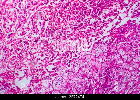 Carcinoma a cellule renali, micrografia leggera, foto al microscopio Foto Stock