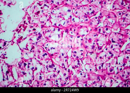 Carcinoma a cellule renali, micrografia leggera, foto al microscopio Foto Stock
