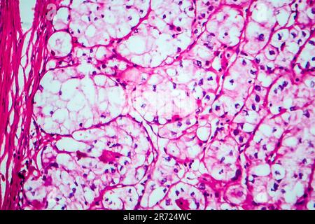 Carcinoma a cellule renali, micrografia leggera, foto al microscopio Foto Stock