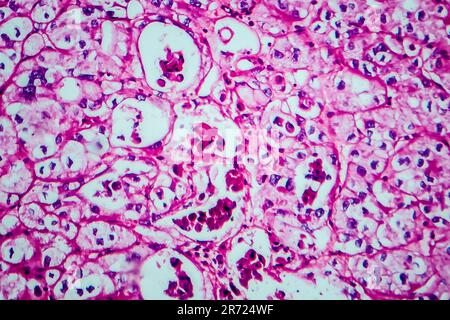 Carcinoma a cellule renali, micrografia leggera, foto al microscopio Foto Stock
