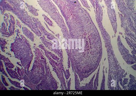 Carcinoma a cellule di transizione della vescica, micrografia luminosa, foto al microscopio Foto Stock