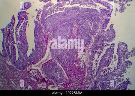 Carcinoma a cellule di transizione della vescica, micrografia luminosa, foto al microscopio Foto Stock