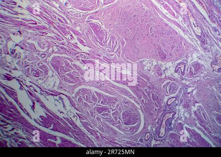 Carcinoma a cellule di transizione della vescica, micrografia luminosa, foto al microscopio Foto Stock