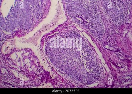 Carcinoma a cellule di transizione della vescica, micrografia luminosa, foto al microscopio Foto Stock