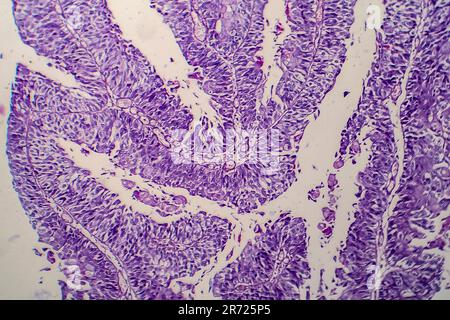 Carcinoma a cellule di transizione della vescica, micrografia luminosa, foto al microscopio Foto Stock