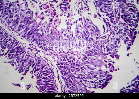 Carcinoma a cellule di transizione della vescica, micrografia luminosa, foto al microscopio Foto Stock