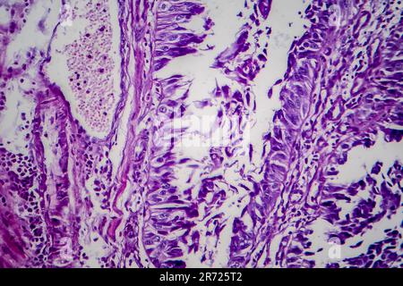 Carcinoma a cellule di transizione della vescica, micrografia luminosa, foto al microscopio Foto Stock