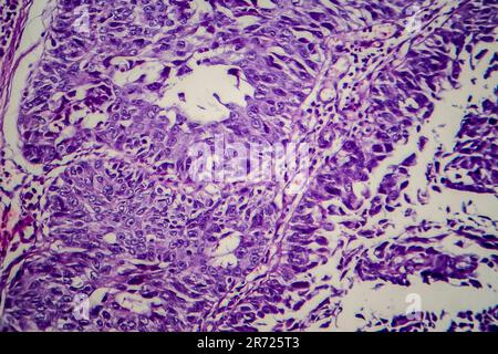 Carcinoma a cellule di transizione della vescica, micrografia luminosa, foto al microscopio Foto Stock