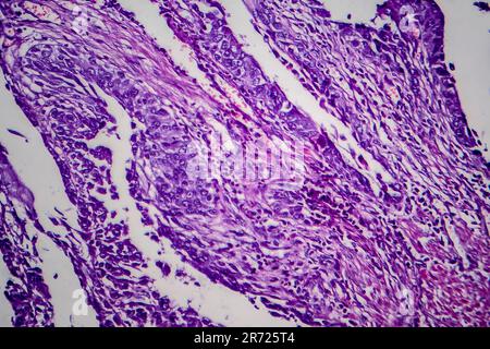 Carcinoma a cellule di transizione della vescica, micrografia luminosa, foto al microscopio Foto Stock