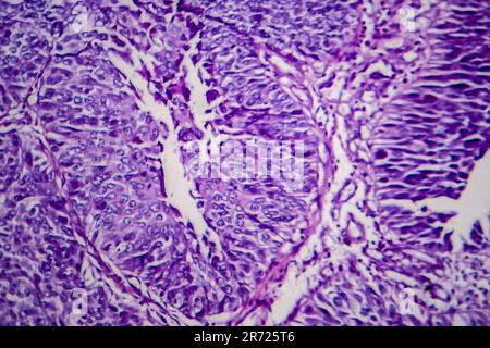 Carcinoma a cellule di transizione della vescica, micrografia luminosa, foto al microscopio Foto Stock