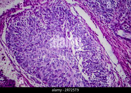 Carcinoma a cellule di transizione della vescica, micrografia luminosa, foto al microscopio Foto Stock