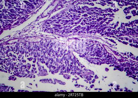 Carcinoma a cellule di transizione della vescica, micrografia luminosa, foto al microscopio Foto Stock