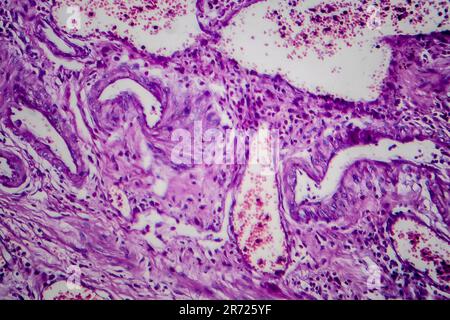 Carcinoma a cellule di transizione della vescica, micrografia luminosa, foto al microscopio Foto Stock