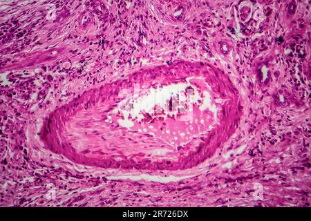 Tubercolosi renale, micrografia leggera, foto al microscopio Foto Stock