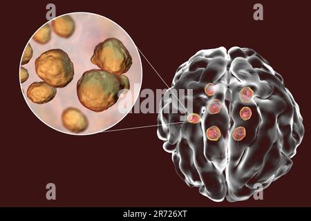 Lesioni multiple del parenchima cerebrale causate dal fungo Cryptococcus neoformans, illustrazione. C. i neoformani sono un organismo simile al lievito. Cryptococcosis è un Foto Stock