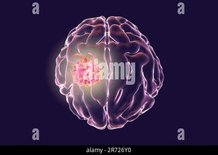 Immagine concettuale per il trattamento del cancro al cervello. Illustrazione del computer che mostra la distruzione del tumore cerebrale. Foto Stock