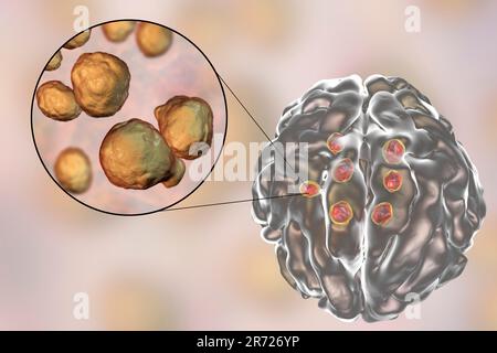 Lesioni multiple del parenchima cerebrale causate dal fungo Cryptococcus neoformans, illustrazione. C. i neoformani sono un organismo simile al lievito. Cryptococcosis è un Foto Stock