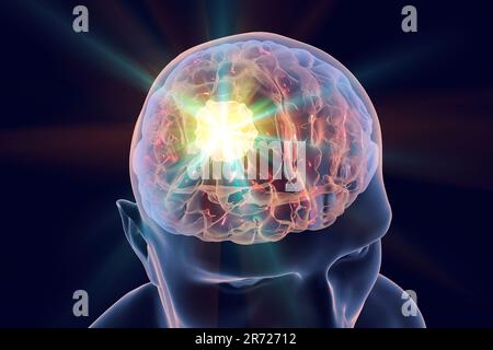 Immagine concettuale per il trattamento del cancro al cervello. Illustrazione del computer che mostra la distruzione del tumore cerebrale. Foto Stock